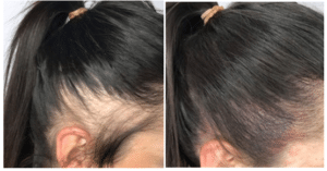 Scalp pigmentatie vrouwen