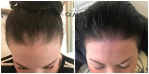 Scalp pigmentatie
